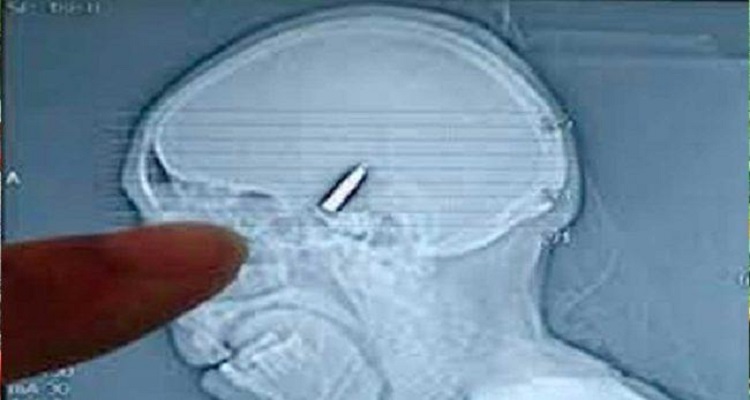 जसले आफ्नै टाउकोमा गोली भएको २० वर्षपछि थाहा पाए