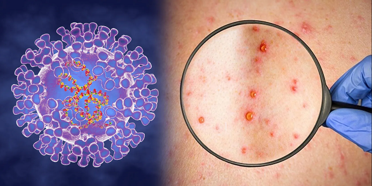 मंकिपक्सको आतंक : नेपालीहरुकाे श्रम गन्तव्य देश यूएईमा पनि भेटियो