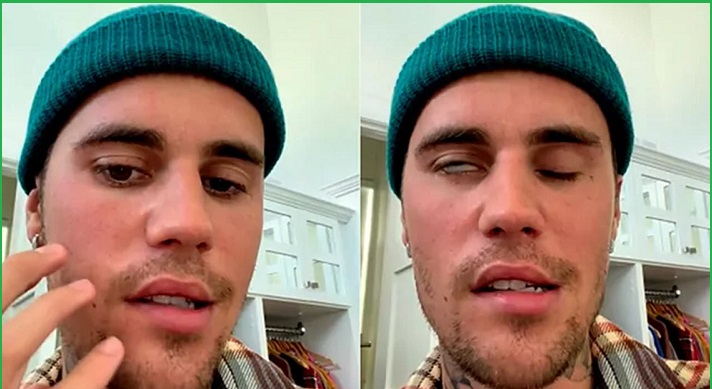 पप गायक जस्टिन बिबरको अनुहारमा पक्षघात